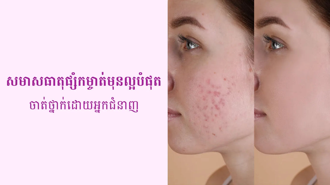 The Best Acne-Fighting Ingredients, Ranked By Experts