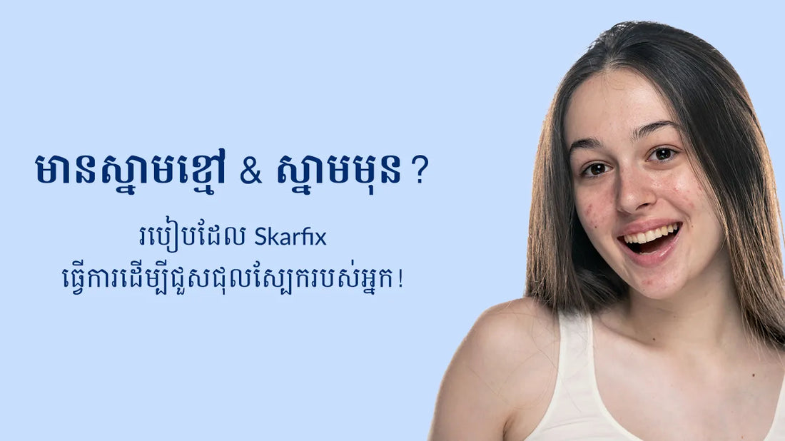 Dark Spots & Acne? How Skarfix Works to Fix Your Skin