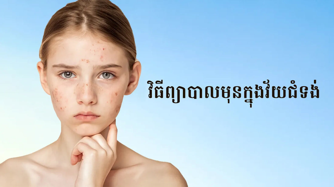 ទម្លាប់ថែរក្សាស្បែកសម្រាប់វ័យជំទង់ដែលមានបញ្ហាមុនជាមួយសេត Salyzap & Sunscreen